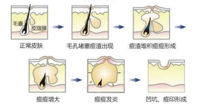 激光去除痘疤