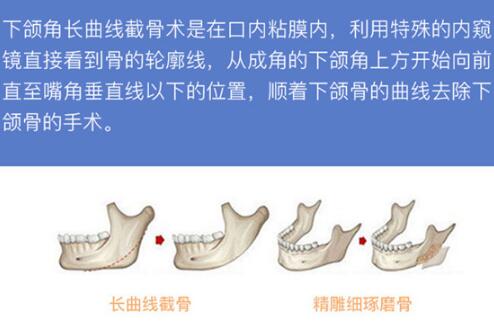 上海九院下颌角磨骨手术科普