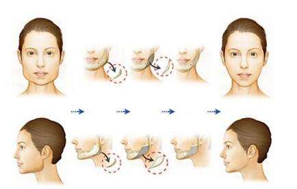 上海九院下颌角磨骨手术科普
