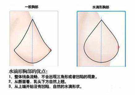 北京八大处整容医院科普隆胸​手术