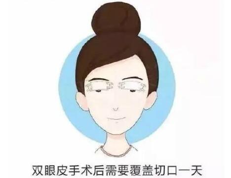 上海九院双眼皮手术科普