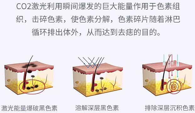 弋矶山医院美容整形科科普激光祛痣