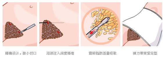 桂林华美整形医院科普腰腹吸脂手术