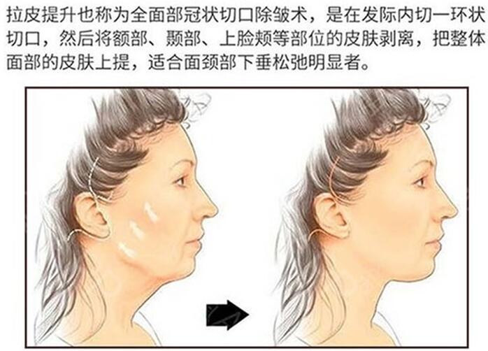 崔东俊医生科普面部紧致提升除皱