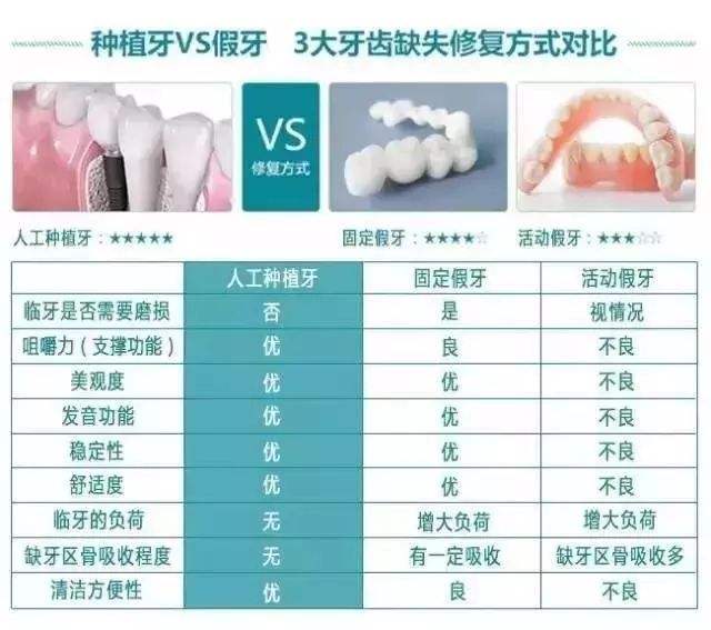 上海九院科普种植牙的优点