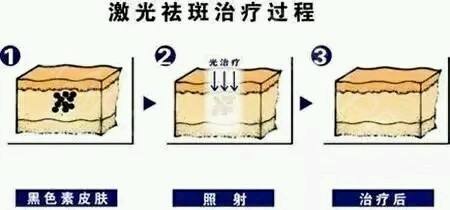 调Q激光的医治黄褐斑实际果