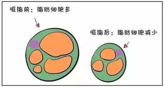 医美减肥方法科普