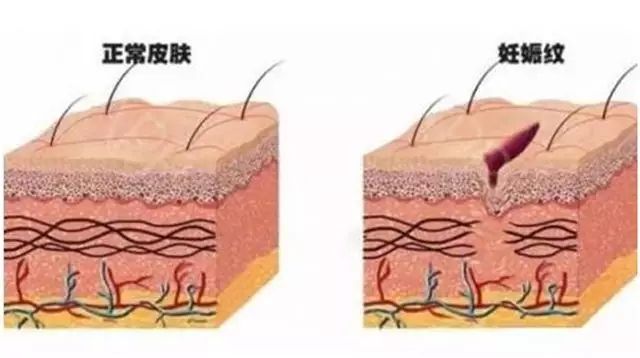 妊娠纹是怎么形成的