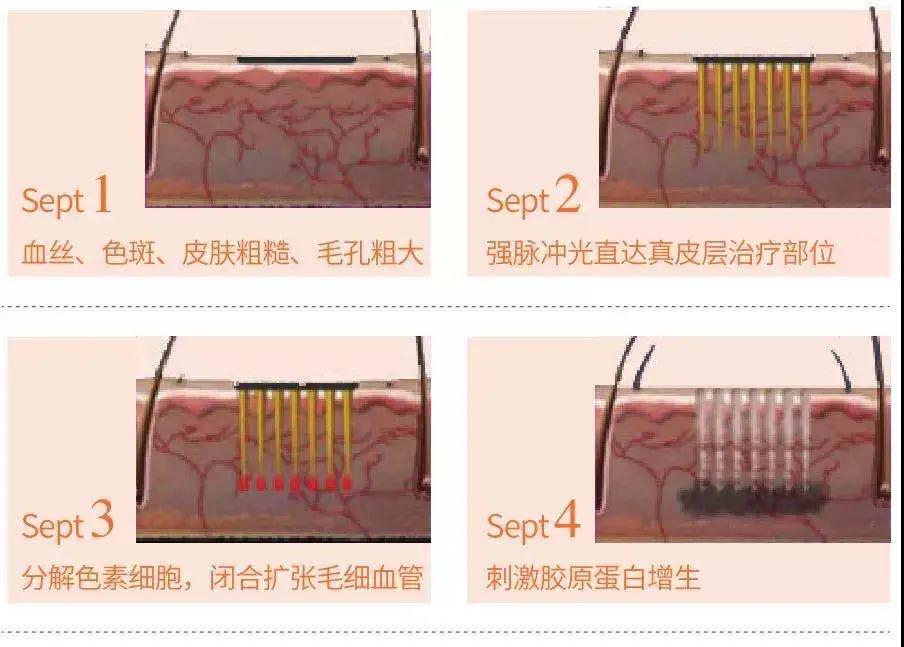 彩光嫩肤祛斑价格