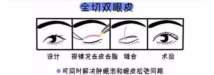 割一只双眼皮多少钱