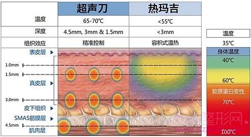 李成明医生科普面部抗衰项目超声提拉