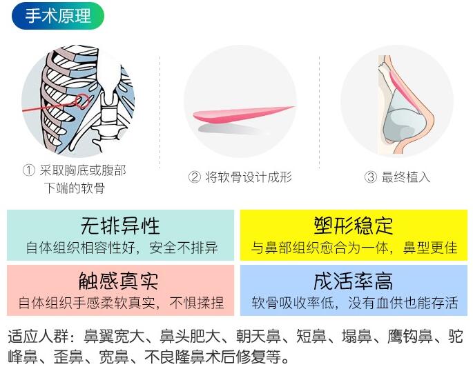 温州美域高高志丹医生科普隆鼻整形