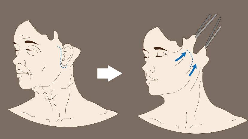 面部拉皮去皱整形
