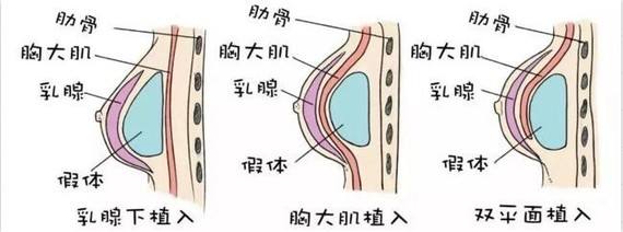 上海玫瑰医疗美容科谱隆胸整形手术