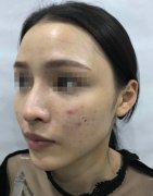 玻尿酸填充太阳凹陷图片对比来了！来看我的术后果真实不真实吧