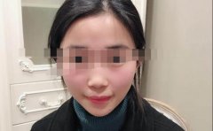 罗志敏隆鼻案例分享!我用我的真实经历告诉你果好不好!