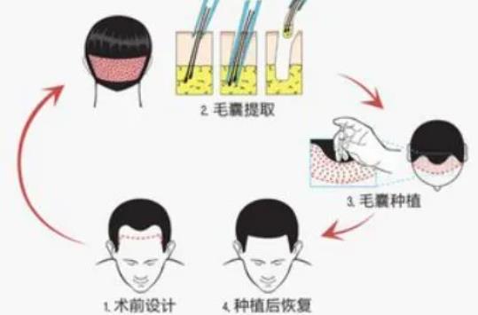 tddp植发技术