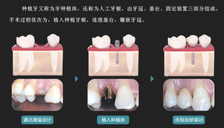 牙齿种植hg11.jpg