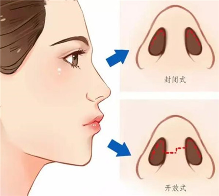 上海华山整形医院隆鼻修复怎么样?说说我的隆鼻经历,价格不贵很舒适值得推荐!