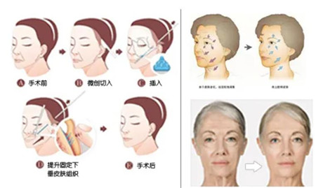 北京东方瑞丽整形医院拉皮怎么样?亲测好评,分享我的美肤日记!