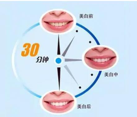 牙齿冷光美白2.jpg
