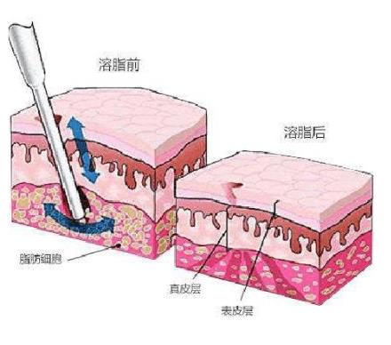 注射溶脂可以去眼袋吗，好处是什么