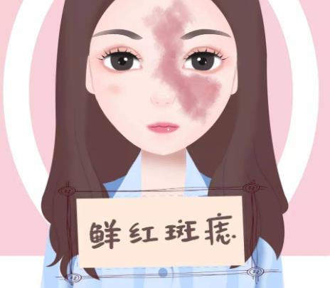 激光调节鲜红斑痣.jpg