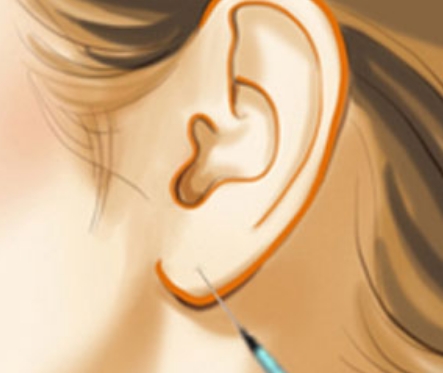 注射玻尿酸丰耳垂有什么效果,能维持多久