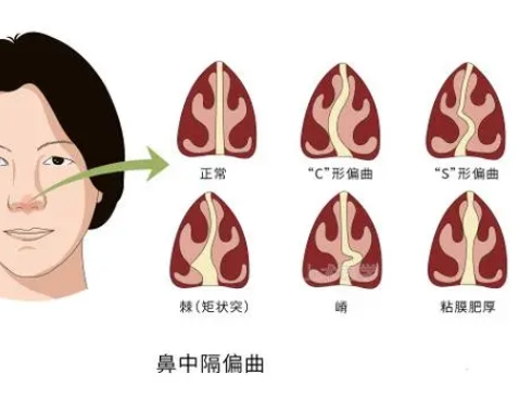 鼻中隔偏曲是什么原因引起的