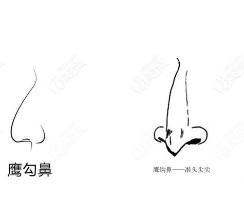 矫正鹰钩鼻安全吗?注意事项有哪些