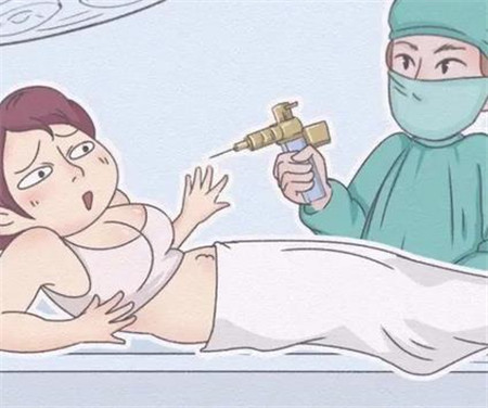深蓝射频溶脂效果如何,有哪些优势