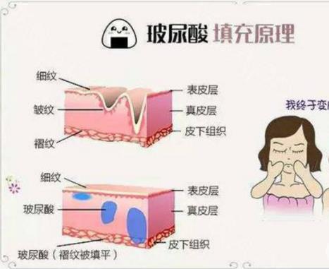 玻尿酸可以直接涂脸吗,有用吗