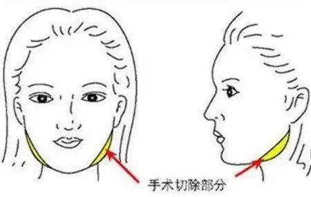 下颌角整形手术是什么意思?是截骨吗