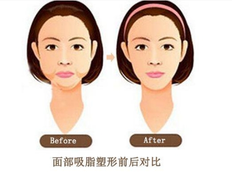为什么面部吸脂手术需要戴头罩