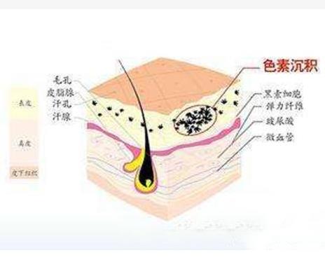 彩光嫩肤效果如何，会反弹吗?