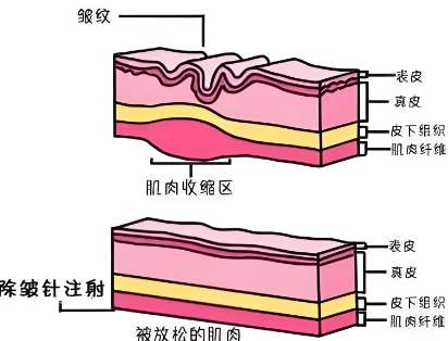 小拉皮和线雕哪个好？线雕反复做可以代替小拉皮吗