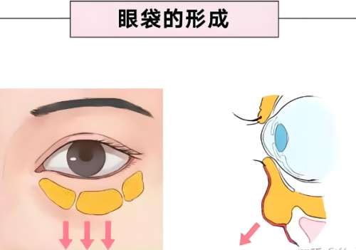 眼袋手术1--10天图片怎么样？注意事项点进查看