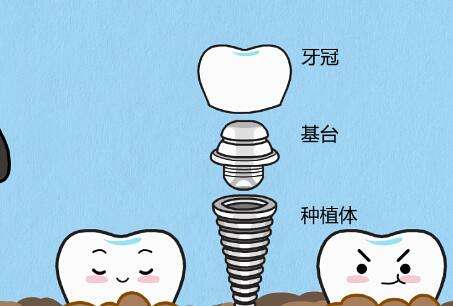 牙冠怎么戴上去全过程怎样?揭秘费用和戴牙冠小tips