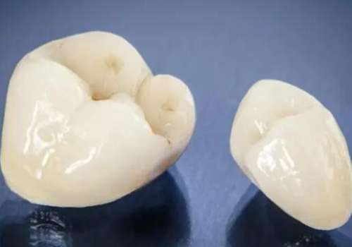 威兰德臻瓷全瓷牙多少钱一颗？真实价格这里有