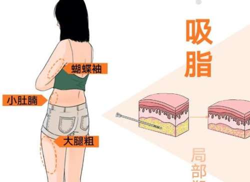 水动力吸脂的脂肪适合填充吗？填脸填胸都可行？一篇说透