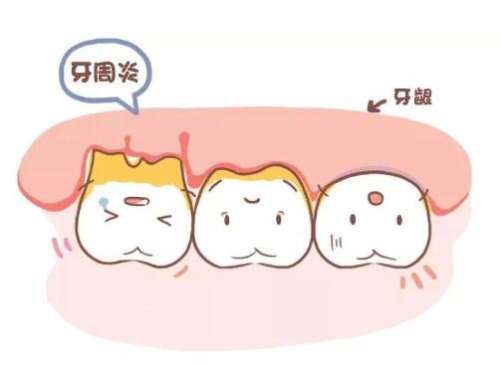 牙周炎.jpg