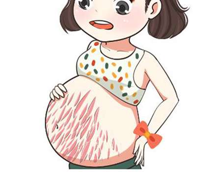 如何去除妊娠纹？了解去除妊娠纹方法有哪些