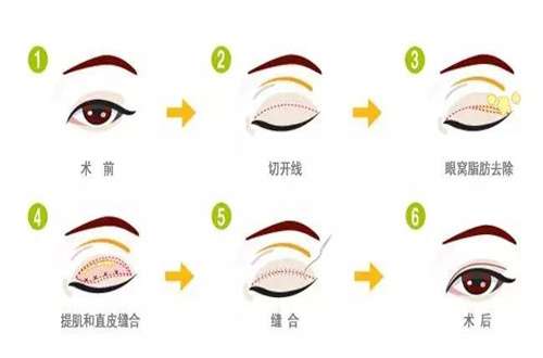男生双眼皮做多宽合适?收集注意事项的资料阐述