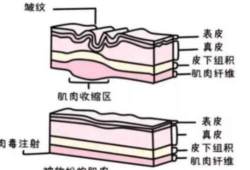 射频去皱纹效果好不好？射频去皱纹维持多久？