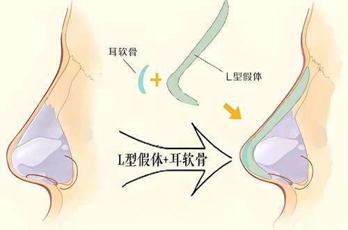 男生隆鼻成功案例分享，一览真是的变化详情