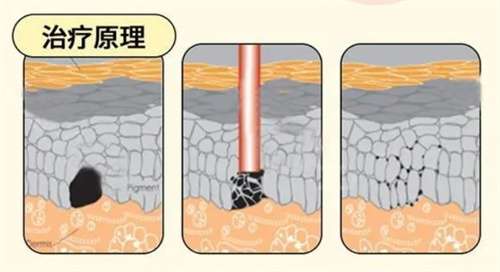 dpl精准光祛斑要做几次才有效果？有什么副作用