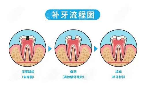 补牙过程分为几个步骤?补牙过程疼不疼?