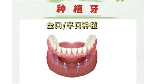种植全口牙对身体有影响吗?术后多久能适应?