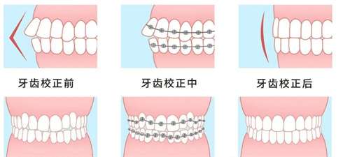 整牙齿矫正多少钱？整牙矫正步骤一览