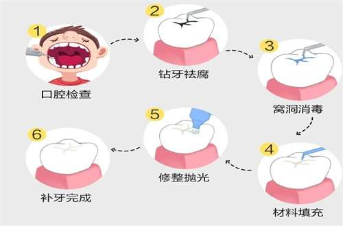 补牙齿一般去医院好还是去诊所好?热门材料解说